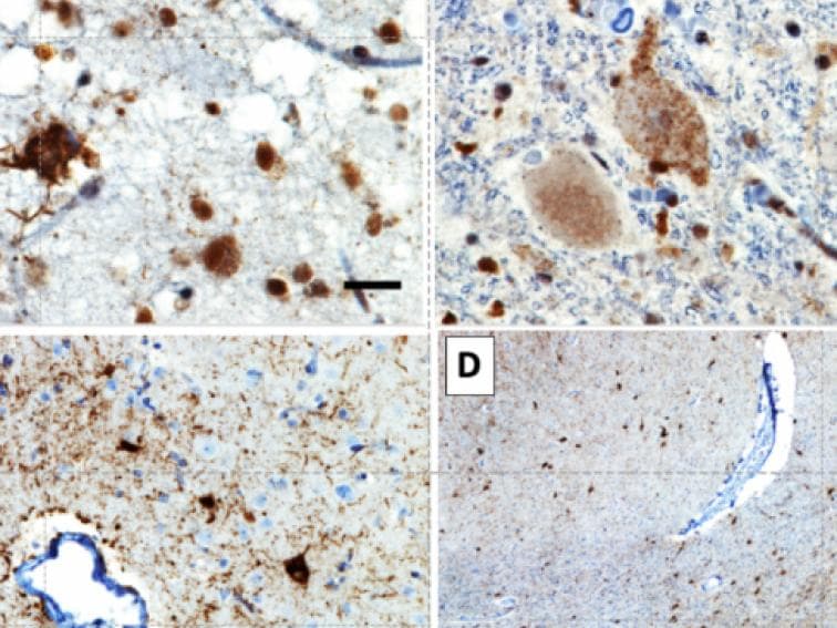 frontotemporal dementia